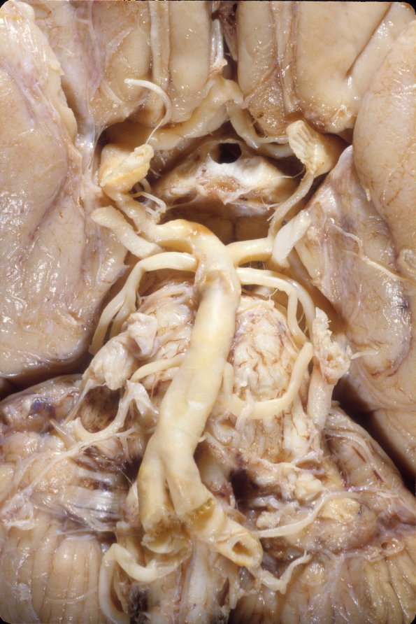 1A6 Circle of WIllis Vasculature (Case 1) 4A