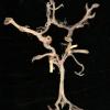 2A1 Circle of WIllis (Case 2) 1