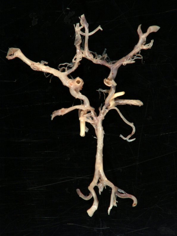 2A1 Circle of WIllis (Case 2) 1