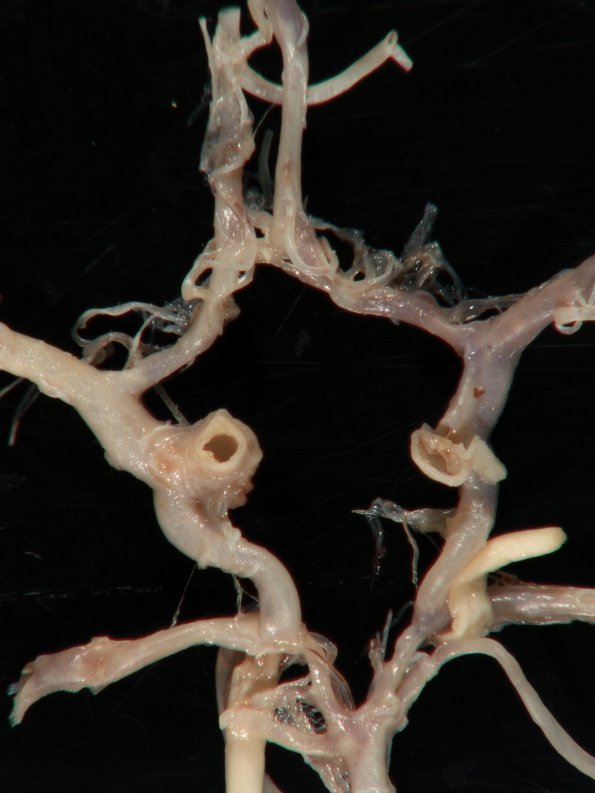 2A2 Circle of Willis (Case 2) 2