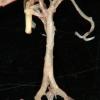 2A3 Circle of Willis (Case 2) 3