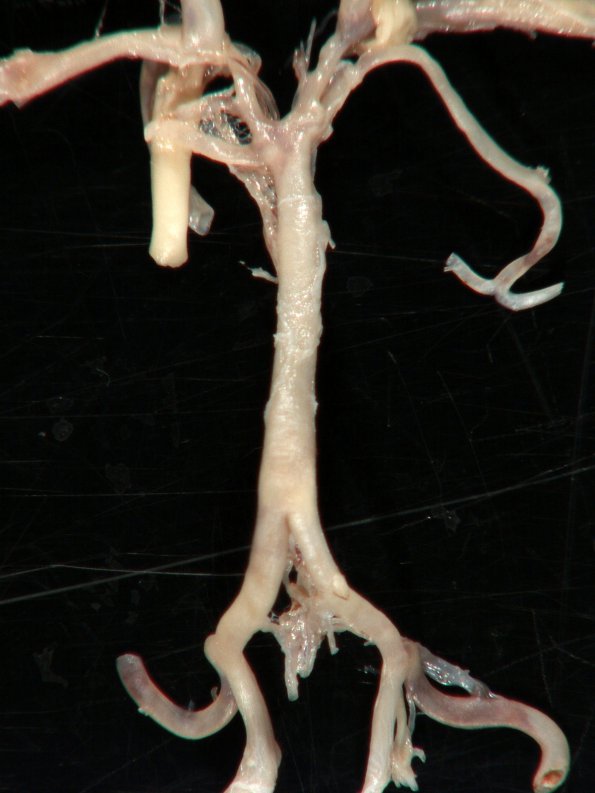 2A3 Circle of Willis (Case 2) 3