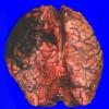 10A1 AD & CAA hemorrhage (Case 10) 3