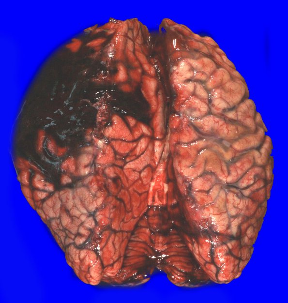 10A1 AD & CAA hemorrhage (Case 10) 3