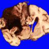 10A2 AD & CAA hemorrhage (Case 10)  11