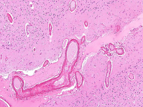 10B1 AD & CAA hemorrhage (Case 10) H&E 11