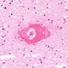 10B2 AD & CAA hemorrhage (Case 10) H&E 1 (2)