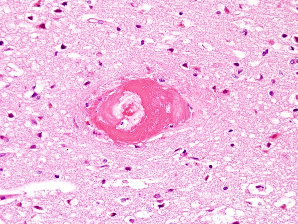 10B2 AD & CAA hemorrhage (Case 10) H&E 1 (2)