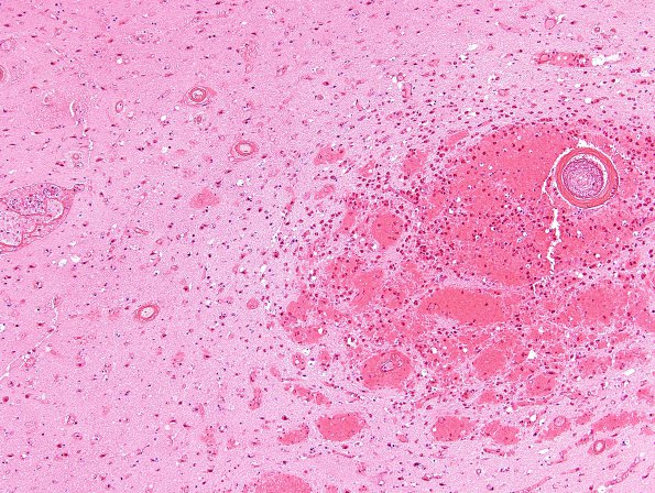 10B3 AD & CAA hemorrhage (Case 10) H&E 5