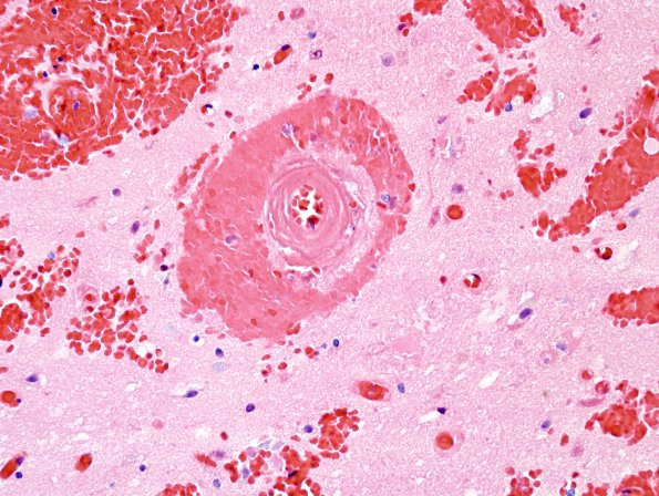 10B4 AD & CAA hemorrhage (Case 10) H&E 7