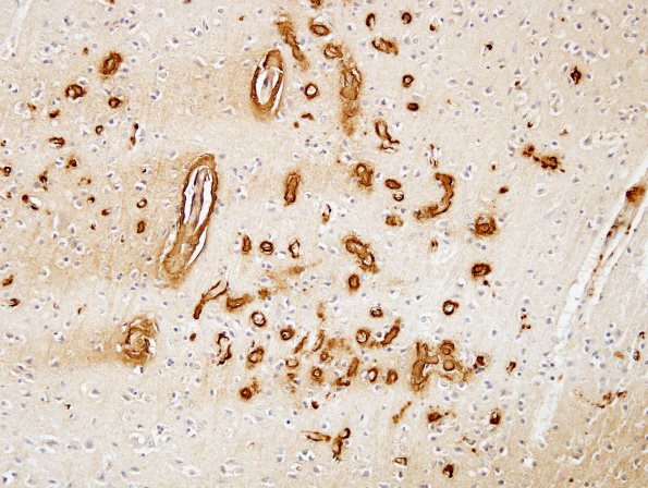 10C2 AD & CAA hemorrhage (Case 10) BAmyloid 6