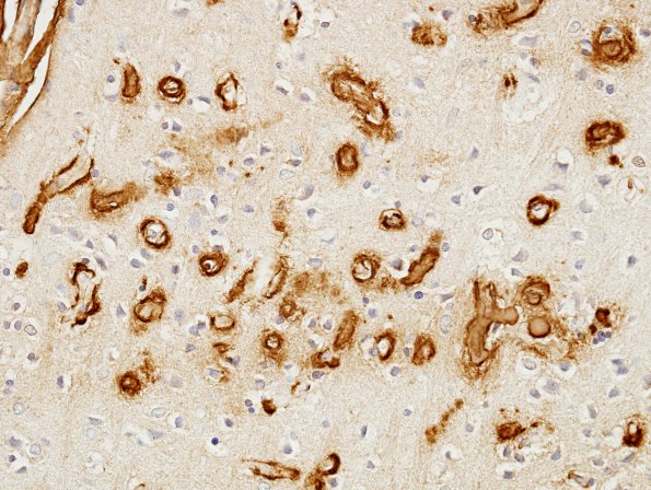 10C3 AD & CAA hemorrhage (Case 10) BAmyloid 5