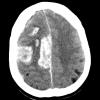 11A1 Congophilic Angiopathy (Case 11) CT 1 - Copy