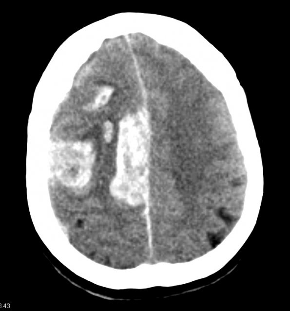 11A1 Congophilic Angiopathy (Case 11) CT 1 - Copy