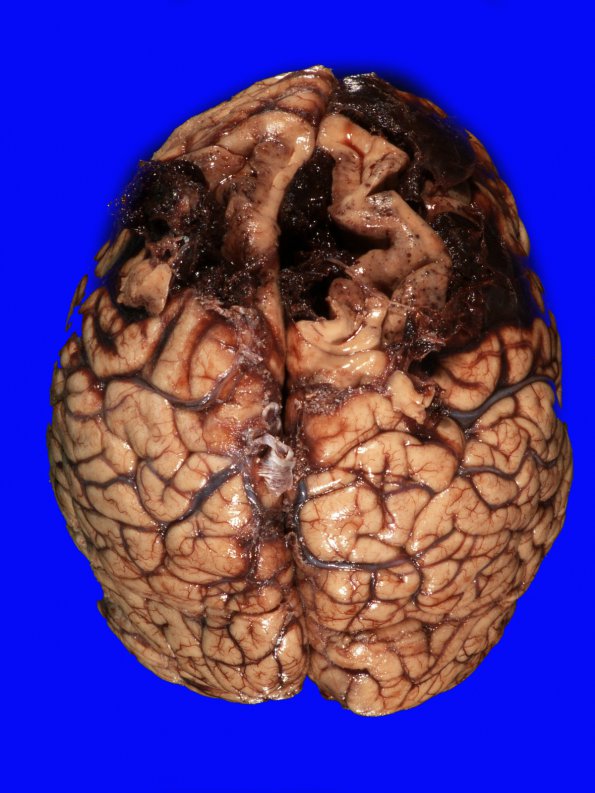 11B1 Congophilic Angiopathy (Case 11) 1