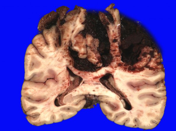 11B2 Congophilic Angiopathy (Case 11) 5