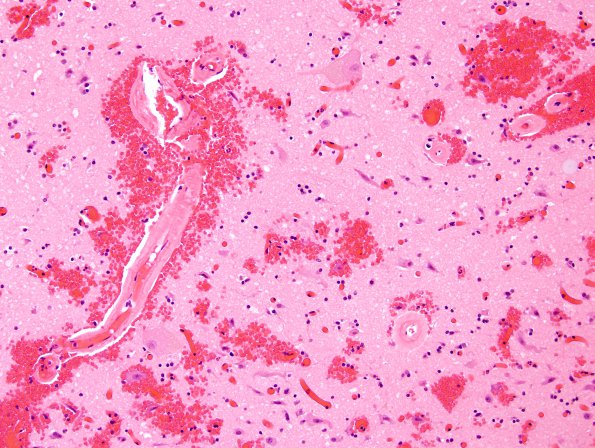 11C1 Congophilic Angiopathy (Case 11) H&E 1