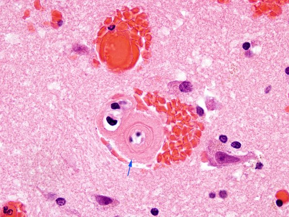 11C2 Congophilic Angiopathy (Case 11) H&E 3 copy