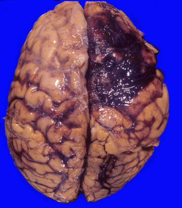 12A1 Hemorrhage, CAA & AD (Case 12) 2