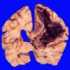 12A2 Hemorrhage, CAA & AD (Case 12) 5