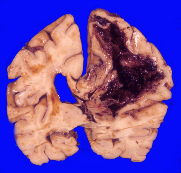 12A2 Hemorrhage, CAA & AD (Case 12) 5