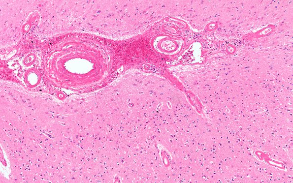 12B Hemorrhage, CAA & AD (Case 12) H&E