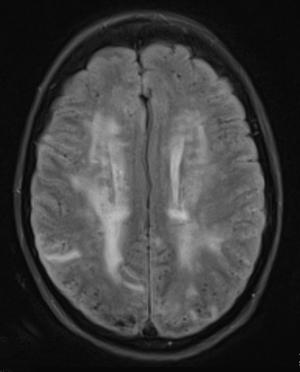 13A1 Congophilic Angiopathy (Case 13) TIRM 1 - Copy