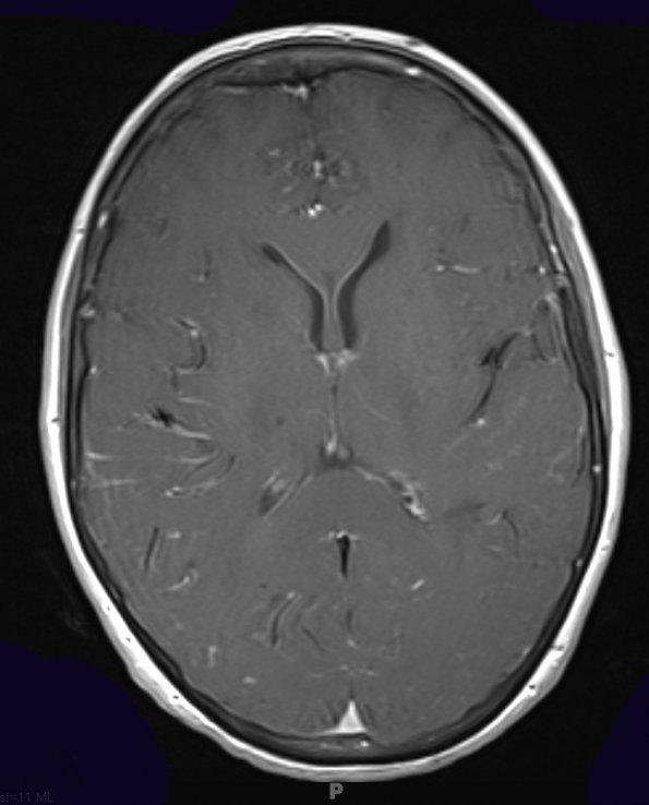 13A2 Congophilic Angiopathy (Case 13) T1 W - Copy