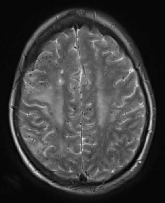 13A3 Congophilic Angiopathy (Case 13) T2 1 - Copy