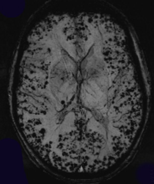 13A4 Congophilic Angiopathy (Case 13) (SWI) 2 - Copy