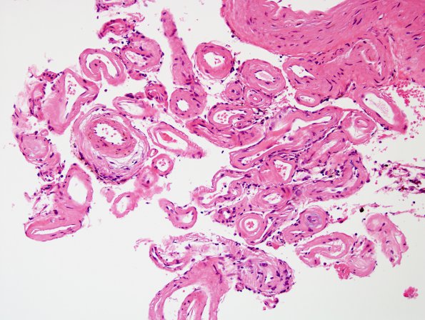 13B1 Congophilic Angiopathy (Case 13) H&E 2