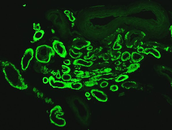 13B3 Congophilic Angiopathy (Case 13) Thio-S 82 - Copy