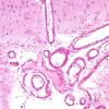 14B1 AD & CAA, Case 14) capillaries H&E 3