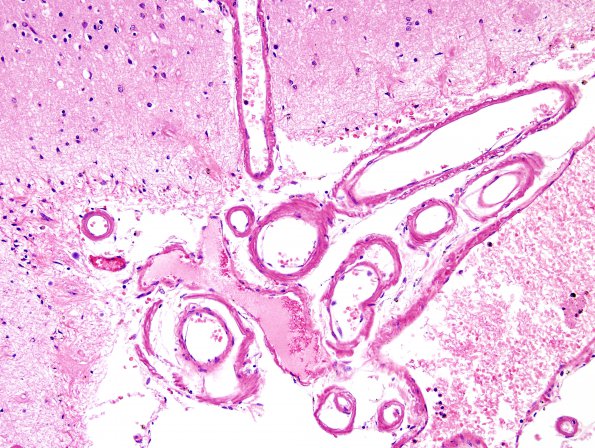 14B1 AD & CAA, Case 14) capillaries H&E 3