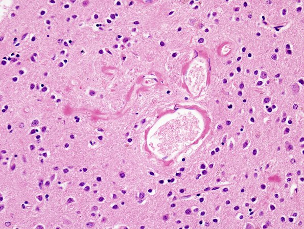 14B2 AD & CAA, Case 14) capillaries H&E 1