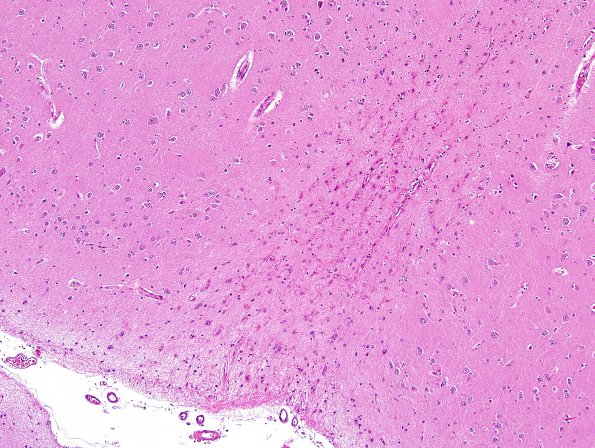 15B2 CAA, Infarct, microscopic (Case 15) H&E 2