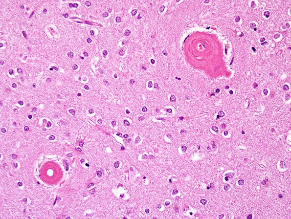 15B3 CAA, Infarct, microscopic (Case 15) H&E 3