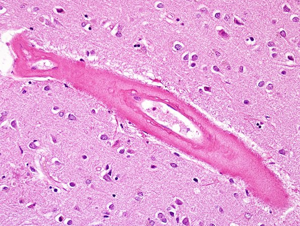 15B4 CAA, Infarct, microscopic (Case 15) H&E 8