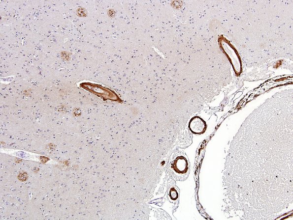 15C CAA, Infarct, microscopic (Case 15) 9 BAmyloid