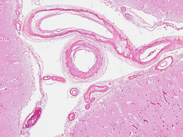 16A1 Congophilic Angiopathy (Case 16) 1 H&E area A