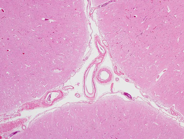 16A3 Congophilic Angiopathy (Case 16) 3 H&E area C