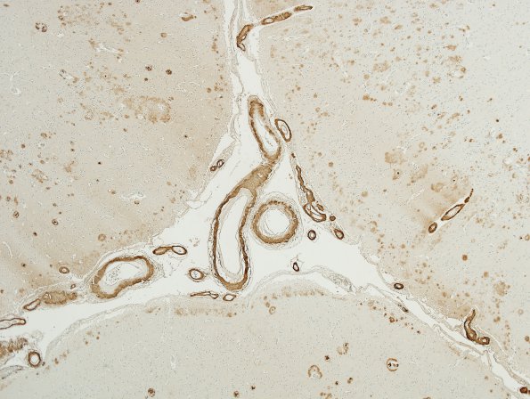 16A4 Congophilic Angiopathy (Case 16) 3 B-Amyloid Area C