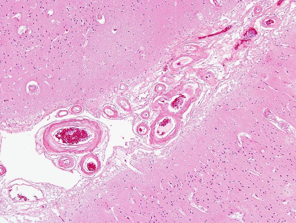 16A5 Congophilic Angiopathy (Case 16) 4 H&E area D