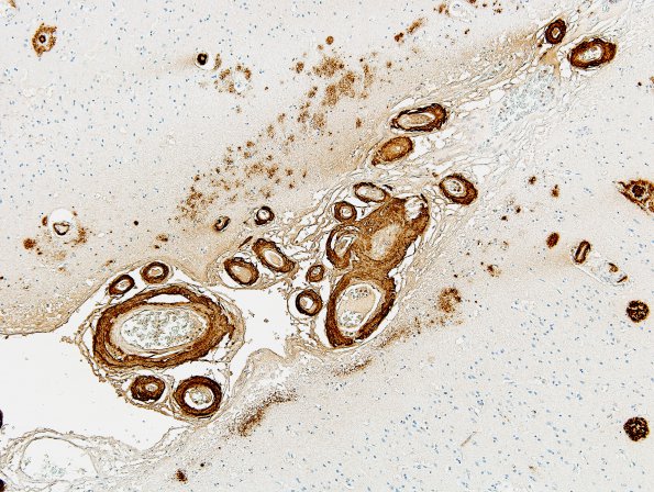 16A6 Congophilic Angiopathy (Case 16) 4 B-Amyloid Area D