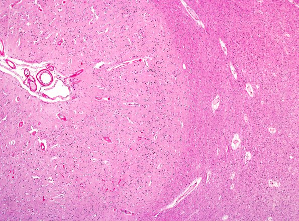 17A2 Congophilic Angiopathy (Case 17) H&E 2A