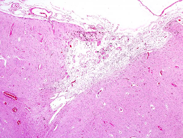 17A5 Congophilic Angiopathy (Case 17) H&E 13