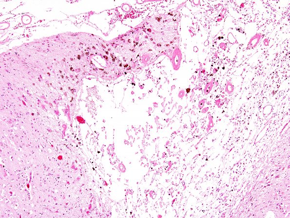 17A6 Congophilic Angiopathy (Case 17) H&E 12A