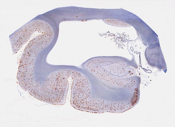 18B1 AD, DLBD, CAA (Case 18) L5 B-Amyloid WM