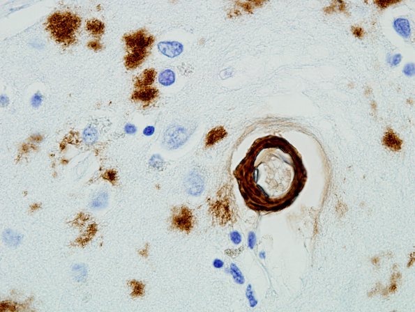 18B2 AD, DLBD, CAA (Case 18) B-Amyloid 100X 2