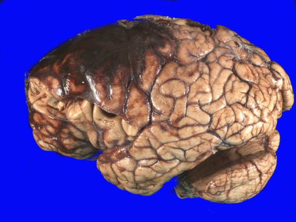 19A1 Congophilic Angiopathy (Case 19) Gross 3